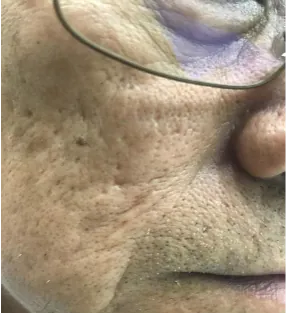 Before IV MSC treatment