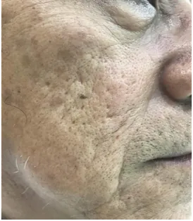 1 month after treatment
